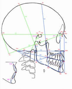 chirurgie-orthognathique